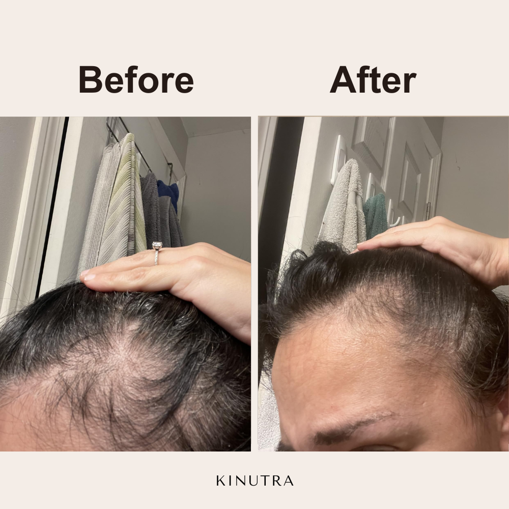 Kinutra Pumpkin Seed Oil with Saw Palmetto - 300 Capsules